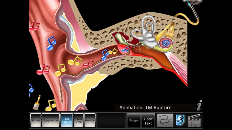 Otitis Media Disorders screenshot-3