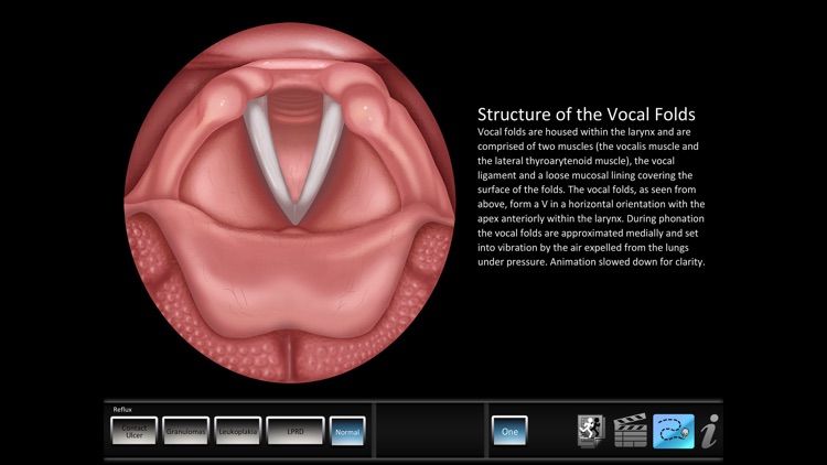 Vocal Pathology: Reflux screenshot-4