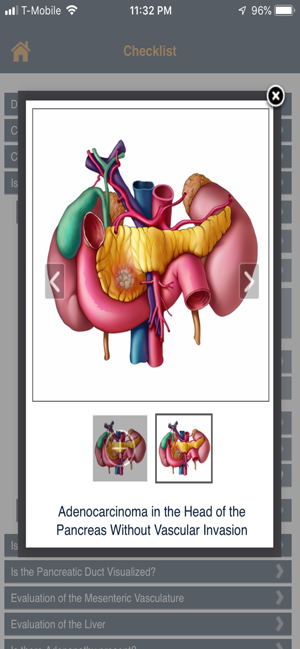 CTisus Pancreas Mass Checklist(圖3)-速報App