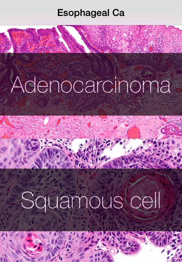 Esophageal Cancer Stage screenshot 2