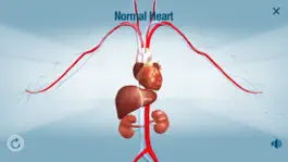 Game screenshot HeartMate 3™ LVAD AR app hack