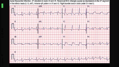 ECG Interpreter Screenshot 3