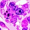 aGVHD Grader is a HIPAA-compliant, fast, and easy-to-use tool for organ staging and overall grading of acute graft-versus-host disease