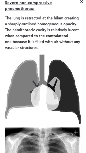 Chest X-Ray Experience(圖5)-速報App