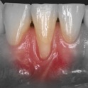 iMuco Récessions gingivales icon