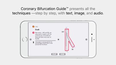 CBG Coronary Bifurcation Guide screenshot 3