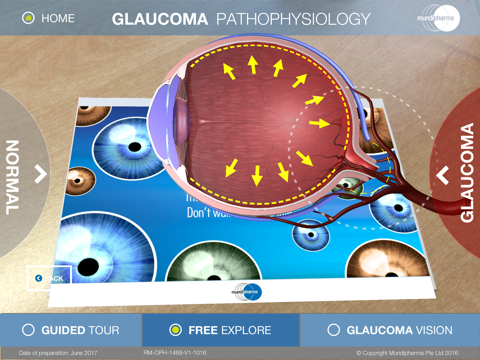 Glaucoma Education screenshot 4