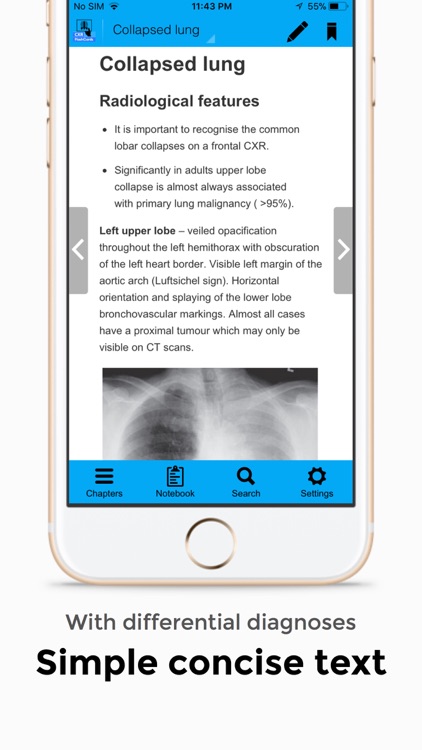 Chest X-Ray FlashCards