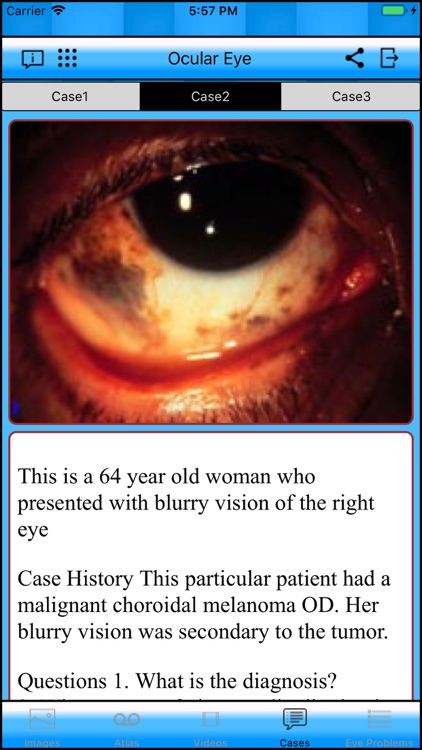 Ocular Eye