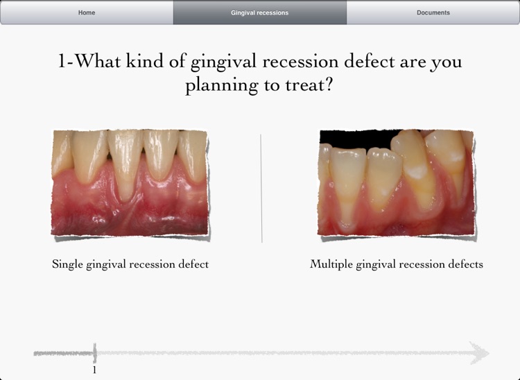 iMuco Gingival recessions