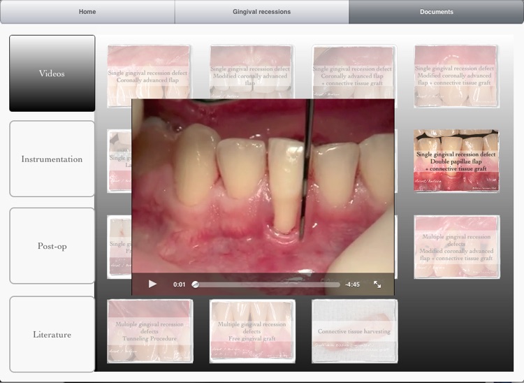 iMuco Gingival recessions screenshot-3