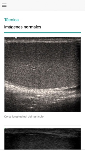 Ecografía Escrotal(圖3)-速報App