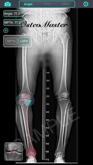 截骨大師 - OsteoMaster(圖3)-速報App