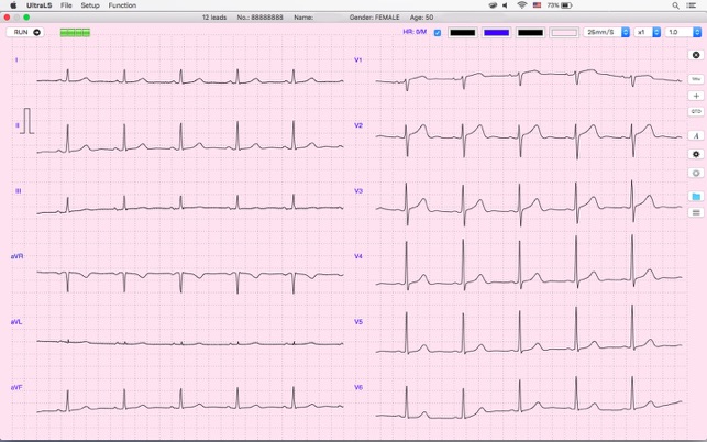 UltraLS  ECG SPO2 TEMP(圖2)-速報App