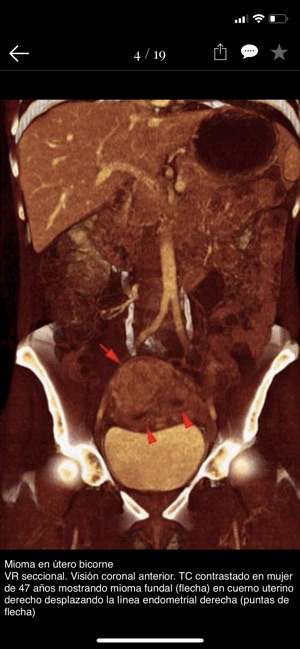 Patología 3D Ginecología(圖4)-速報App