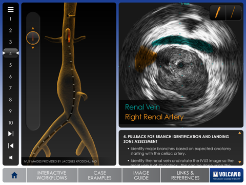 Aortic IVUS screenshot 2