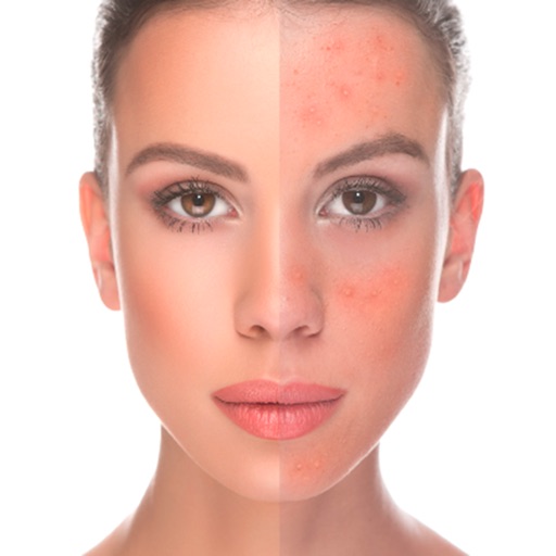 Rosacea Treatment-Natural Home Remedies and Diet icon