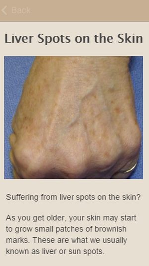 How To Remove Liver Spots