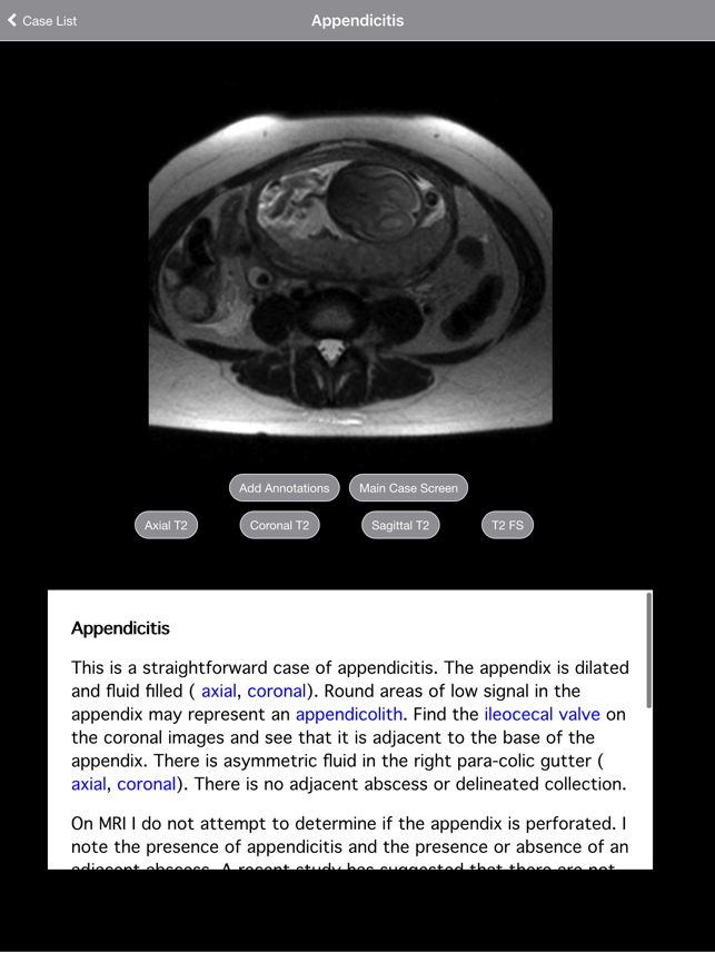 Radiology 2.0: Pregnant Appendicitis(圖3)-速報App