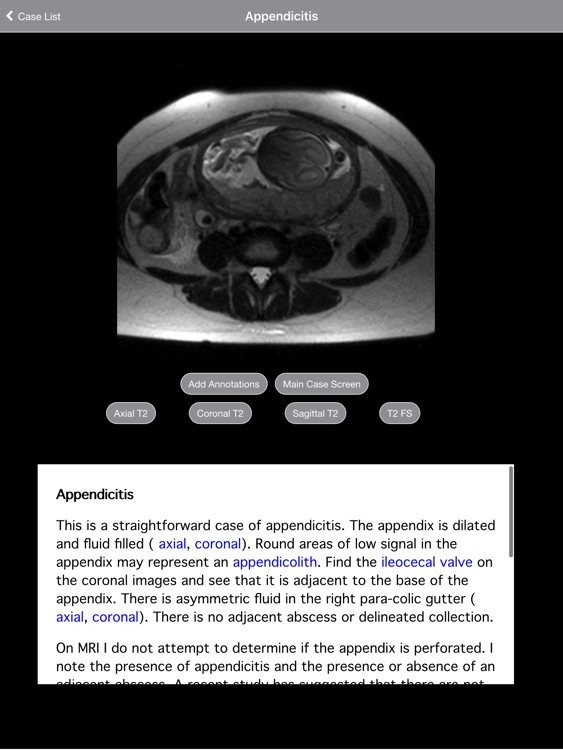Radiology 2.0: Pregnant Appendicitis