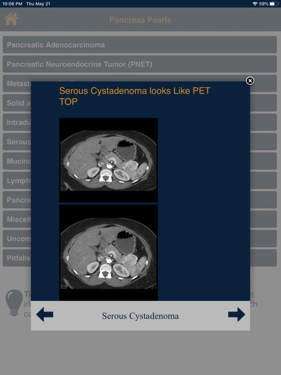 CTisus Pancreatic Tumor Pearls screenshot-3
