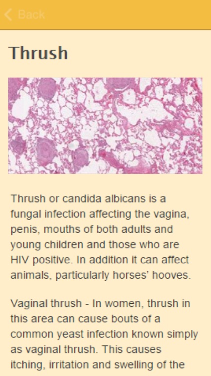 Symptoms Of Thrush