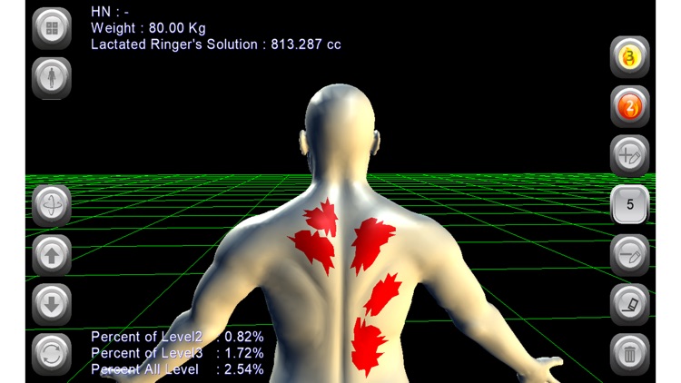 3D Burn Resuscitation