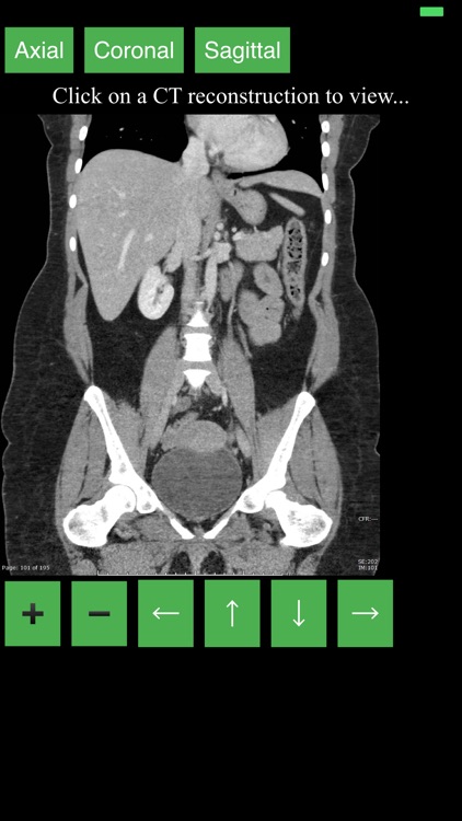 CT Abdomen Pelvis