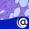 Multiple Myeloma @PoC Multiple Myeloma @PoC