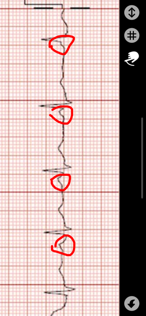 ECG Caliper(圖6)-速報App