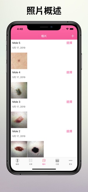 皮膚癌檢查(圖3)-速報App