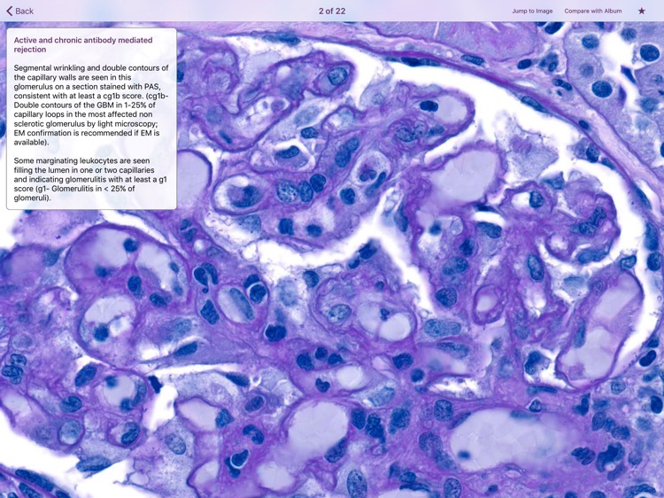 Renal Transplant Pathology