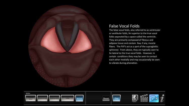 Vocal Pathology: Reflux