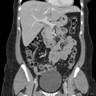 CT Abdomen Pelvis