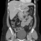 CT Abdomen Pelvis