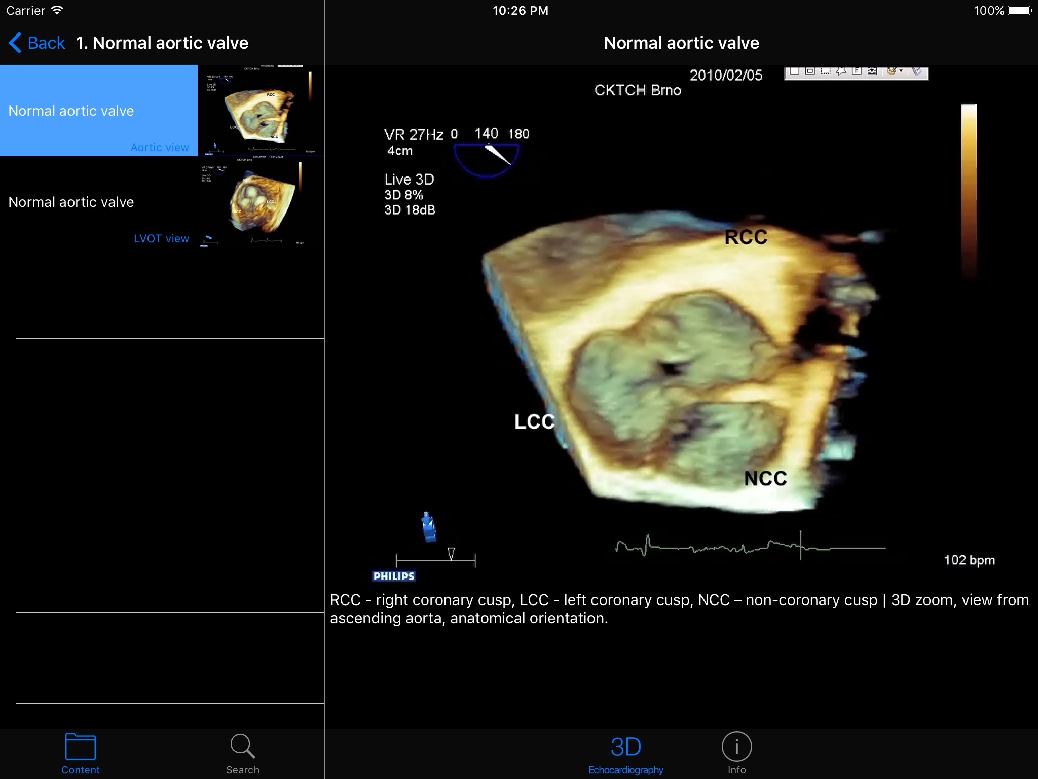 CARDIO3®3D Echocardiography HD screenshot 2