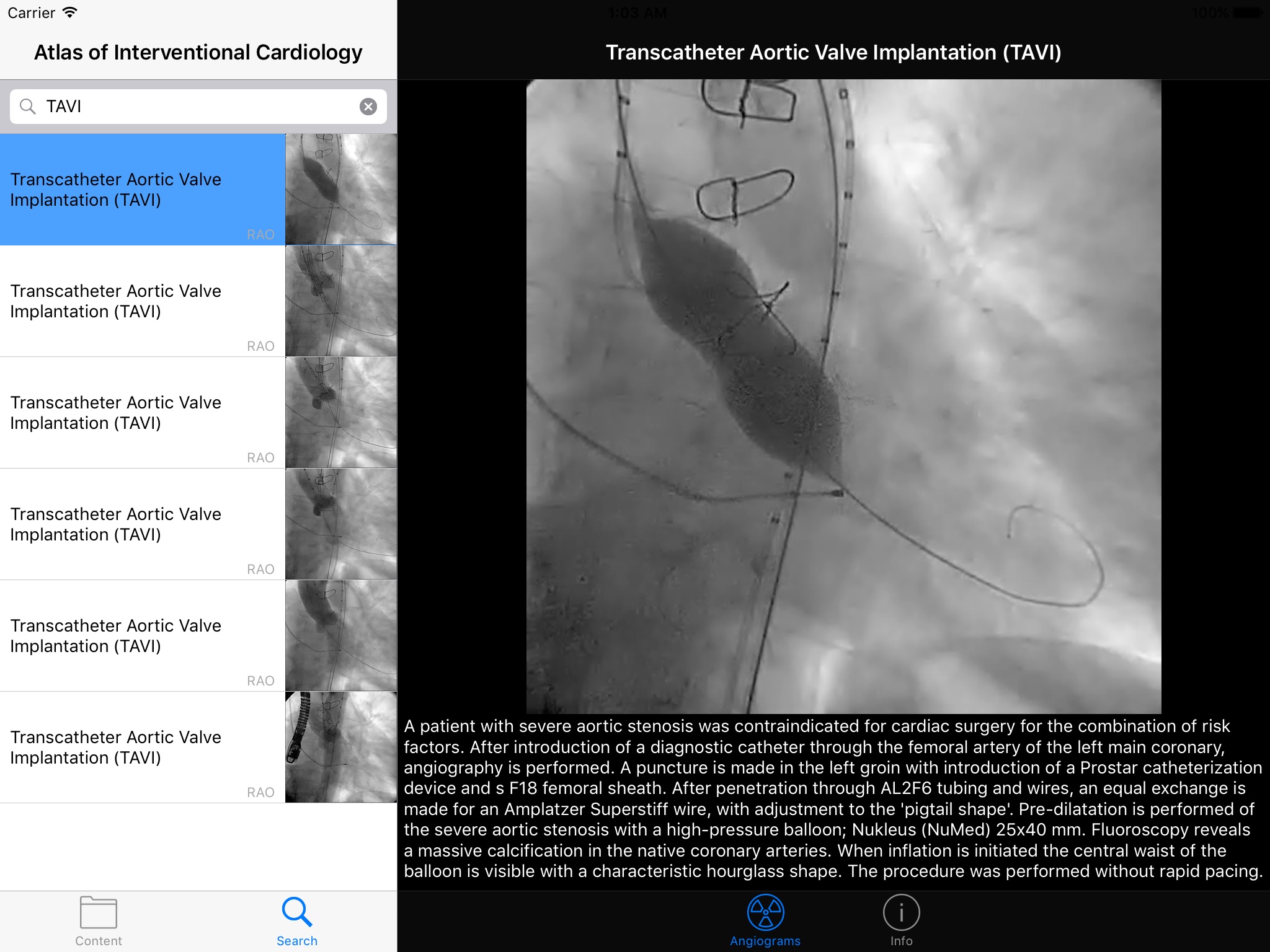 CARDIO3®Invasive Cardiology HD screenshot 2