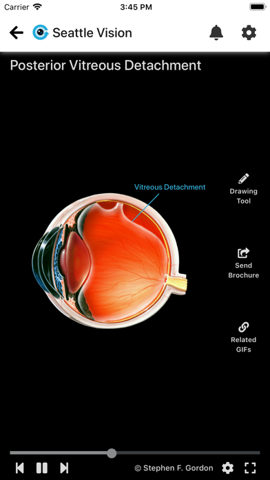 Eye GIFs - Patient Education screenshot 2