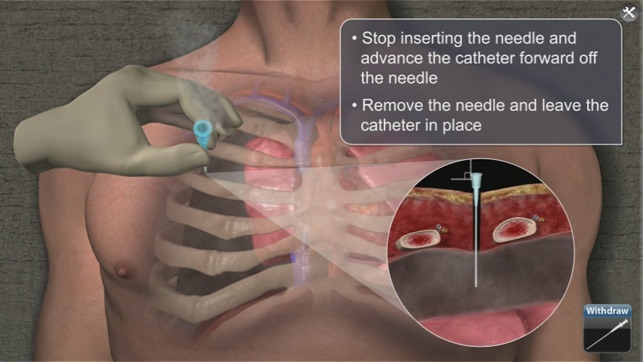 Medrills: NCD for Pneumothorax(圖3)-速報App