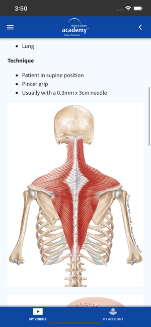 DGSA Dry Needling Videos(圖6)-速報App