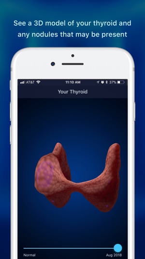 Thyroid Nodule & Cancer Guide(圖2)-速報App