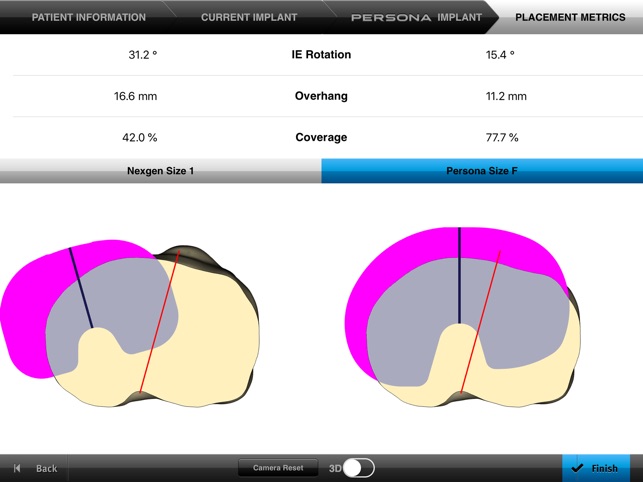 Persona® TKA Tibial Placement(圖2)-速報App