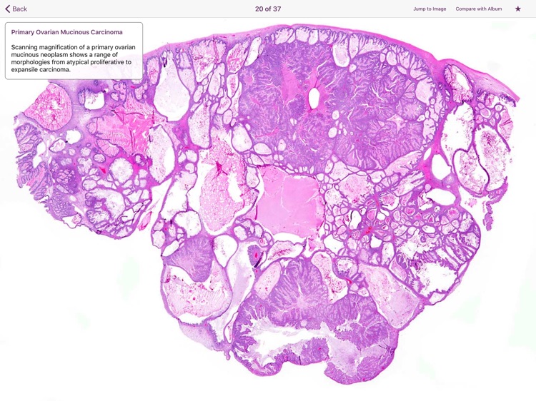 Ovarian Tumor Pathology