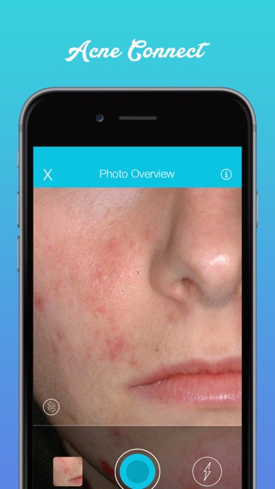 Acne Connect screenshot 2