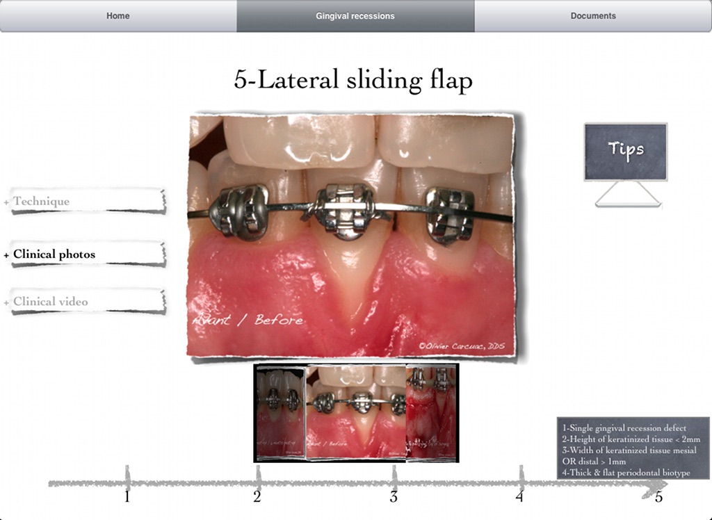 iMuco Récessions gingivales screenshot 3