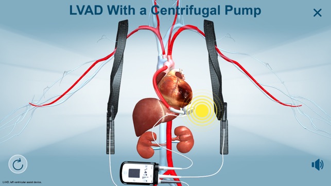 HeartMate 3™ LVAD AR app(圖4)-速報App