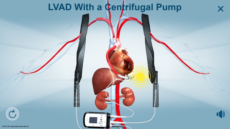 HeartMate 3™ LVAD AR app screenshot-3