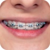 Braces Photo Editor - Make Me Fake Braces