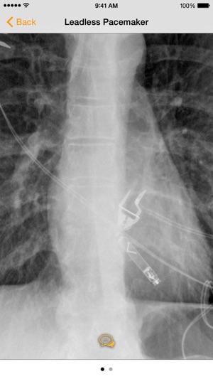 Medical Devices on Chest X-Ray(圖2)-速報App