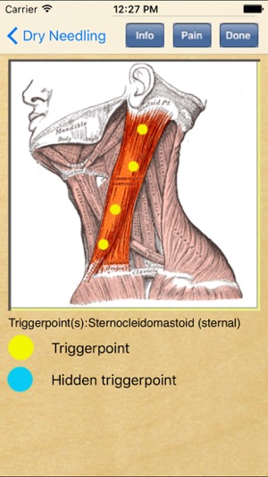 Dry Needling Therapy